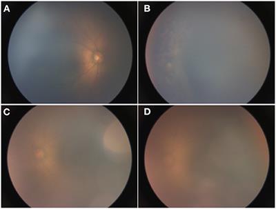 Case Report: Glaucoma in an Infant With Retinopathy of Prematurity